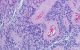 Ependymoma cells by David Ellison, PhD