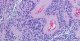 Ependymoma cell