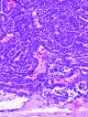 Choroid plexus carcinomas