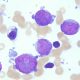 Acute megakaryoblastic leukemia (AMKL)