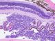 Retinoblastoma xenograft