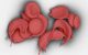 Scientific image of Sickle Cell Disease