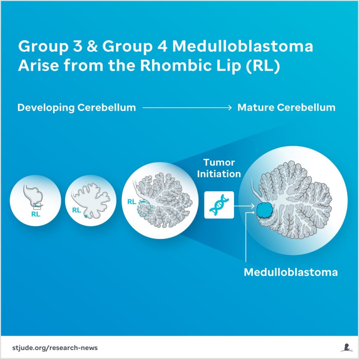 Group 3 and group 4 medulloblastoma arise from the rhombic lip.