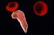 A sickle cell compared to two normal cells