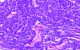 What is a Solid Tumor?
