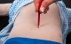 Inserting the catheter