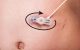 Clean around feeding tube