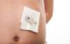 Split gauze dressing