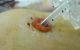 Granulation tissue