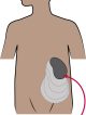 Image of enlarging spleen in a child