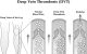 deep vein thrombosis