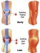 Early and late sensation in knee joint bleed