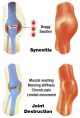 Synovitis and joint destruction from a knee joint bleed