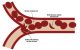Sickled cells blocking blood flow