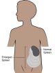 Splenectomy