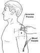 Injection site in arm