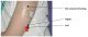 Subcutaneous Tissue Infusion Set
