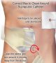 Correct way to clean around suprapubic catheter (graphic)