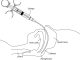 Nasopharyngeal wash