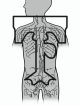 total lymphatic irradiation