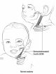 Torticollis