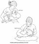Torticollis