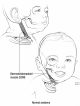 Torticollis