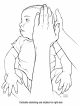 Torticollis