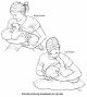 Torticollis