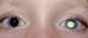 Eyes with retinoblastoma