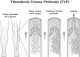 Thrombosis Venosa Profunda (TVP)