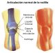Hemorragias en la articulación en hemofílicos