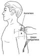 Zona de aplicación de una inyección intramuscular (IM) en la parte superior del brazo.