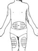 injections sites