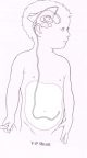 ventriculo-peritoneal shunt